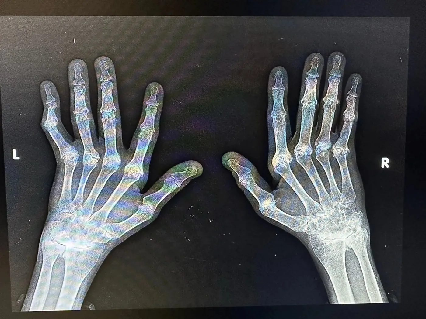 X-ray of Ron Lev's hands showing rheumatoid arthritis joint damage